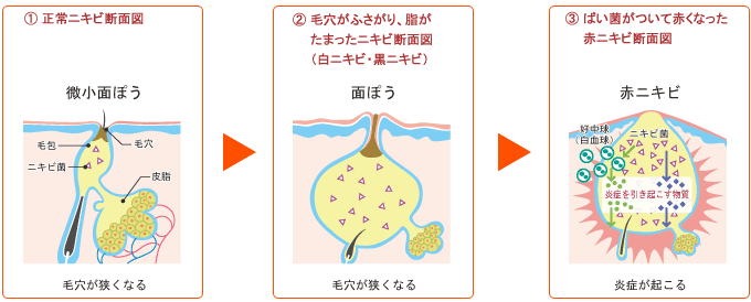 1. 正常ニキビ断面図　2. 毛穴がふさがり、脂がたまったニキビ断面図（白ニキビ・黒ニキビ）　3. ばい菌がついて赤くなった赤ニキビ断面図